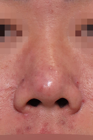 Short nose and bulbous tip correction — 2 weeks at Kobijou Rhinoplasty Clinic. Front