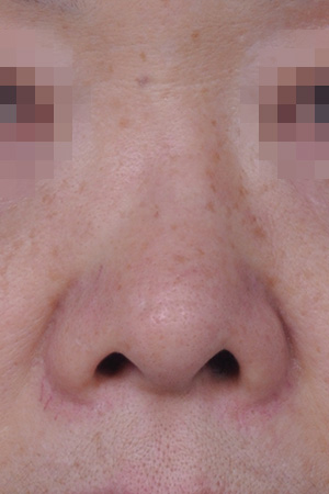 Deviated nose correction with bridge augmentation — 6 weeks at Kobijou Rhinoplasty Clinic. Front