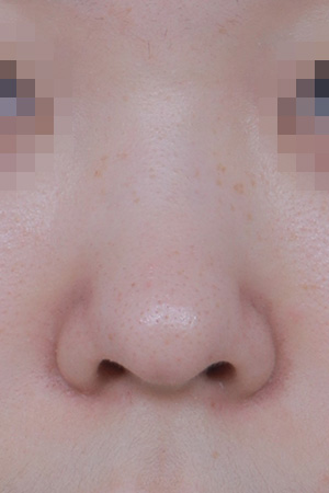 Low bridge and bulbous tip correction — 2 weeks at Kobijou Rhinoplasty Clinic. Front
