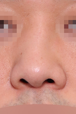 Revision surgery following nasal fracture — 2 weeks at Kobijou Rhinoplasty Clinic. Front
