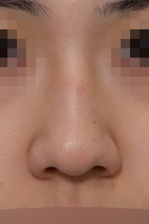 Nasal hump and deviation correction — 3 months at Kobijou Rhinoplasty Clinic. Front