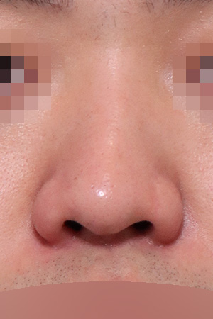 Revision surgery for a low and deviated nose — 2 weeks at Kobijou Rhinoplasty Clinic. Front