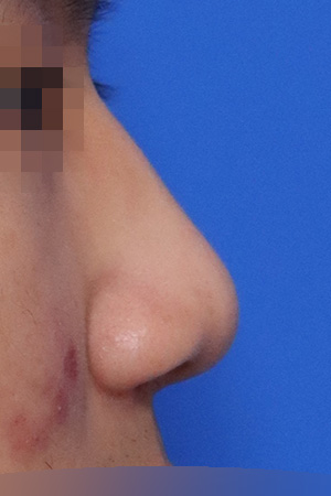 Drooping and bulbous tip correction with septal surgery — 2 weeks at Kobijou Rhinoplasty Clinic. Side
