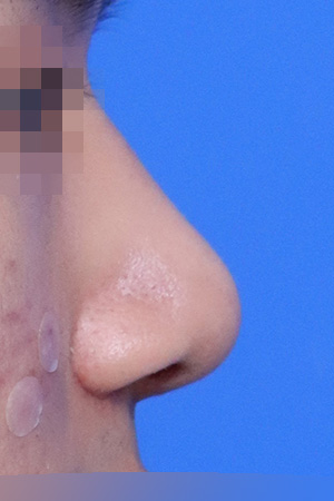 Drooping and bulbous tip correction with septal surgery — 2 weeks at Kobijou Rhinoplasty Clinic. Side