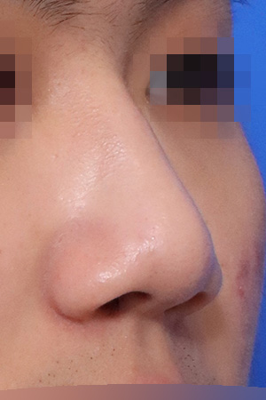 Drooping and bulbous tip correction with septal surgery — 2 weeks at Kobijou Rhinoplasty Clinic. Oblique