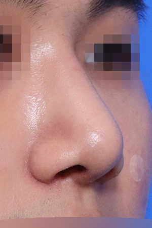 Drooping and bulbous tip correction with septal surgery — 2 weeks at Kobijou Rhinoplasty Clinic. Oblique