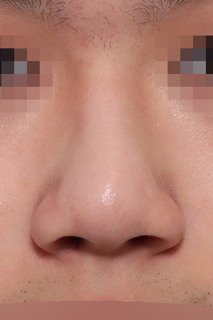 Drooping and bulbous tip correction with septal surgery — 2 weeks at Kobijou Rhinoplasty Clinic. Front