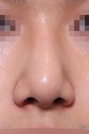 Drooping and bulbous tip correction with septal surgery — 2 weeks at Kobijou Rhinoplasty Clinic. Front