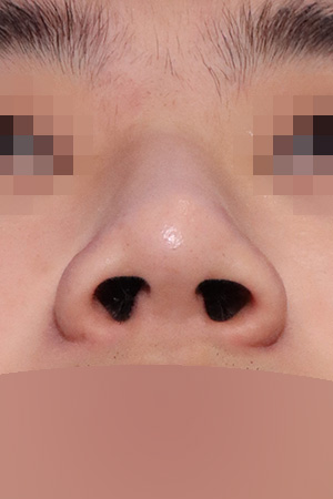 Drooping and bulbous tip correction with septal surgery — 2 weeks at Kobijou Rhinoplasty Clinic. Nasal base