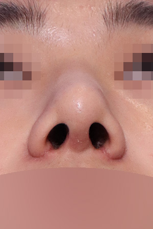 Drooping and bulbous tip correction with septal surgery — 2 weeks at Kobijou Rhinoplasty Clinic. Nasal base