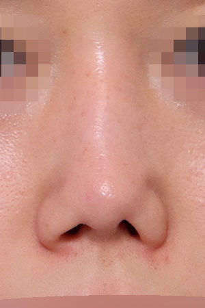 Contracted nose with septal reconstruction — 2 weeks at Kobijou Rhinoplasty Clinic. Front