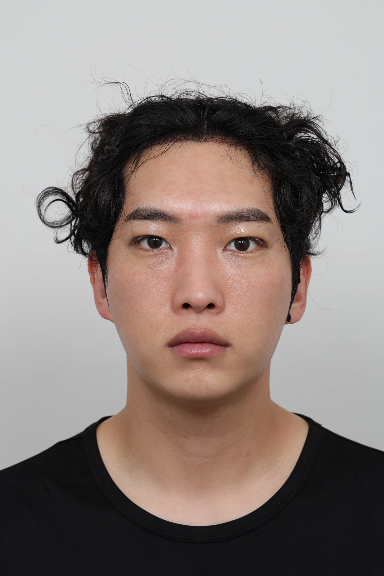 Nose and facial profile — collection 03 at Le J Plastic Surgery Clinic. Le J Clinic, Seoul, collection 03: front view; initial op-folder photograph.