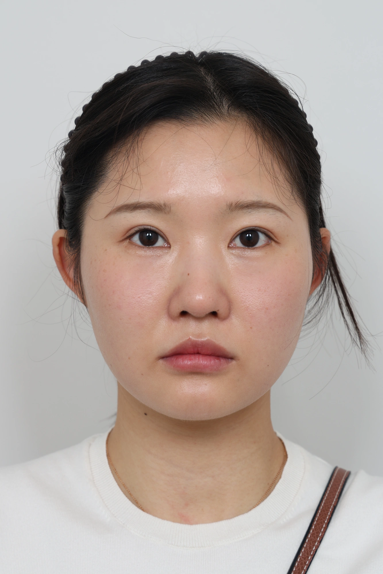 Nose and facial profile — collection 04 at Le J Plastic Surgery Clinic. Le J Clinic, Seoul, collection 04: front view; source folder labelled 3 months.