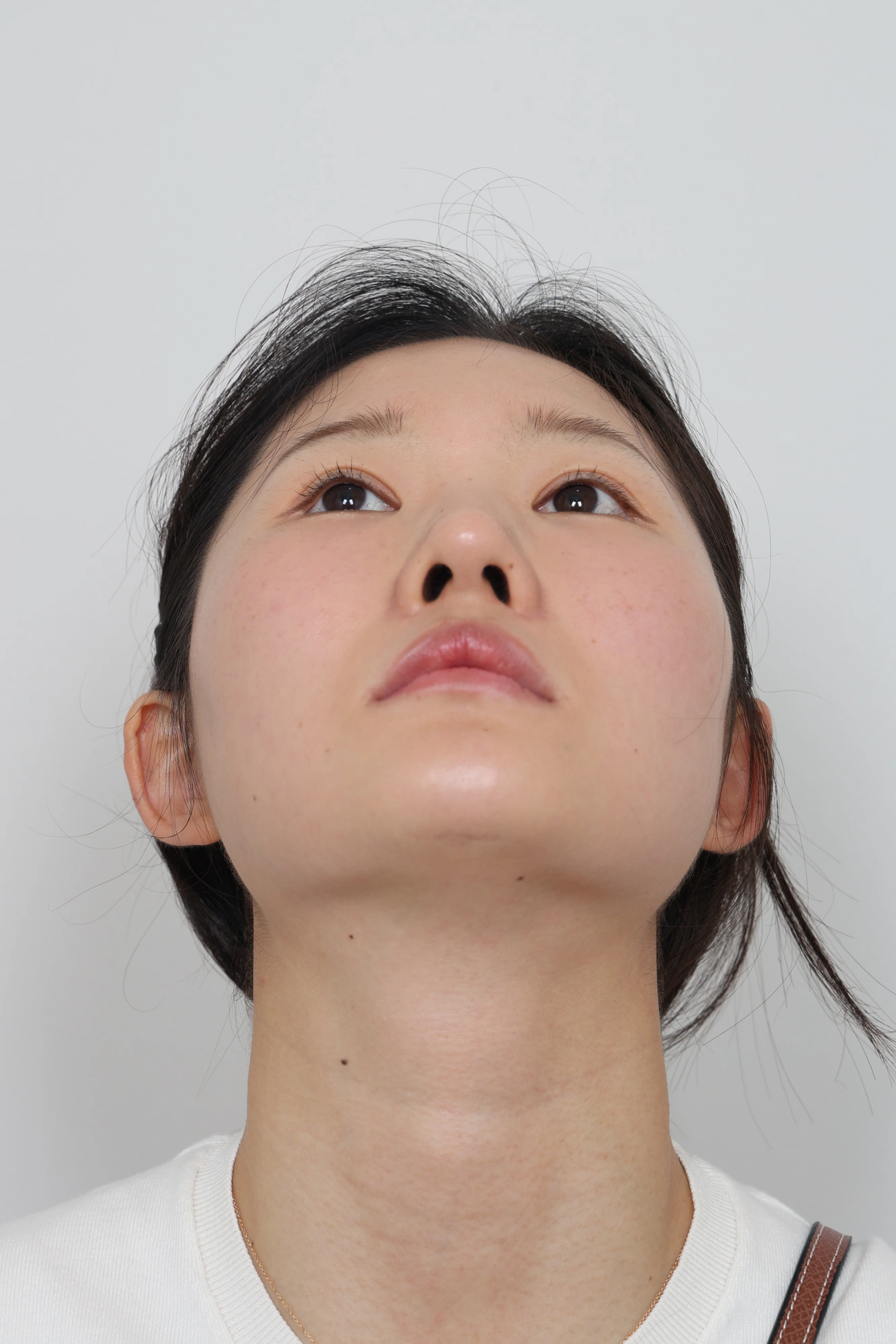 Nose and facial profile — collection 04 at Le J Plastic Surgery Clinic. Le J Clinic, Seoul, collection 04: angled view; source folder labelled 3 months.