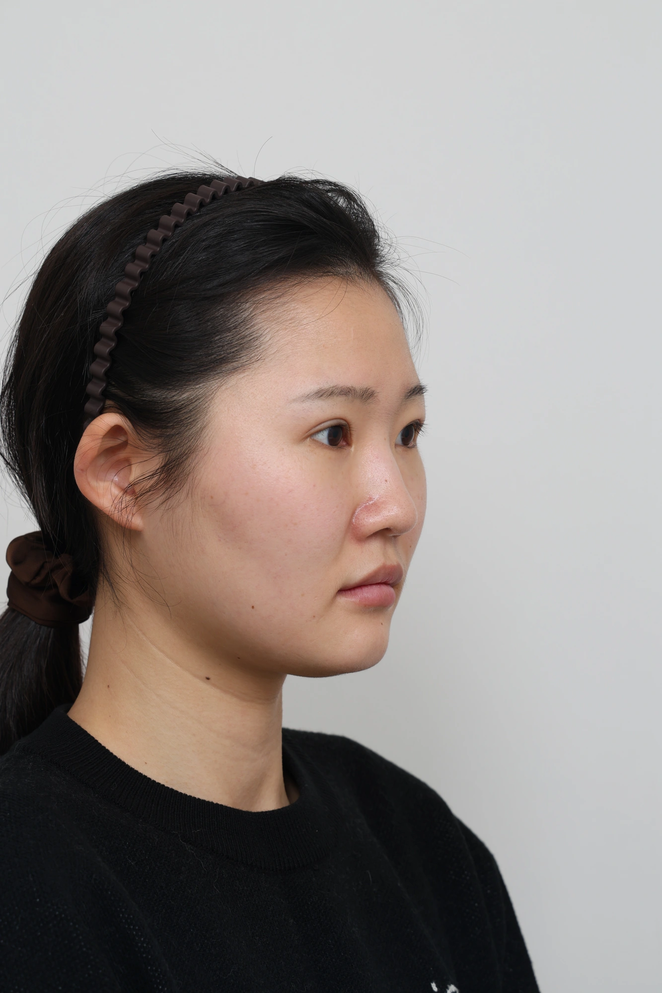 Nose and facial profile — collection 04 at Le J Plastic Surgery Clinic. Le J Clinic, Seoul, collection 04: angled view; initial op-folder photograph.