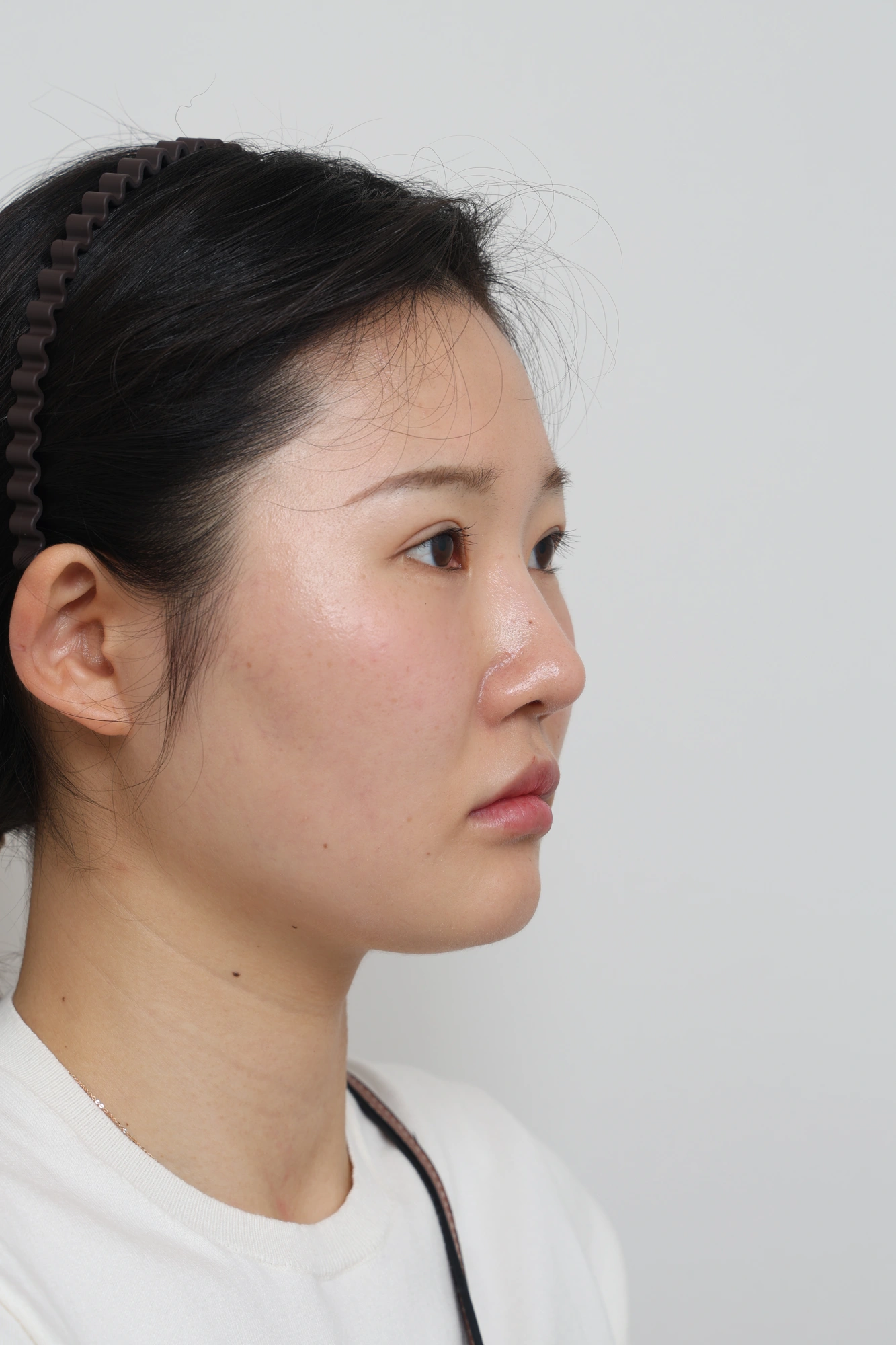 Nose and facial profile — collection 04 at Le J Plastic Surgery Clinic. Le J Clinic, Seoul, collection 04: side view; source folder labelled 3 months.