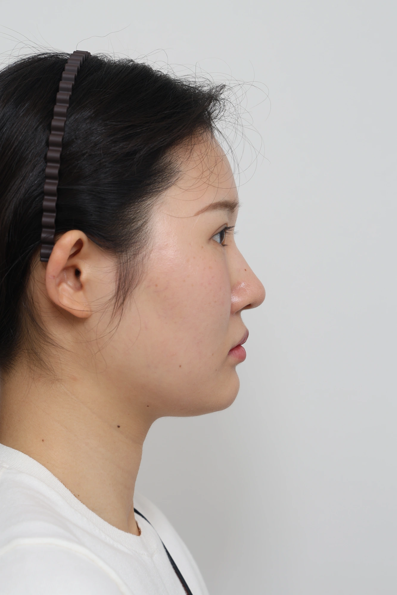 Nose and facial profile — collection 04 at Le J Plastic Surgery Clinic. Le J Clinic, Seoul, collection 04: opposite angled view; source folder labelled 3 months.