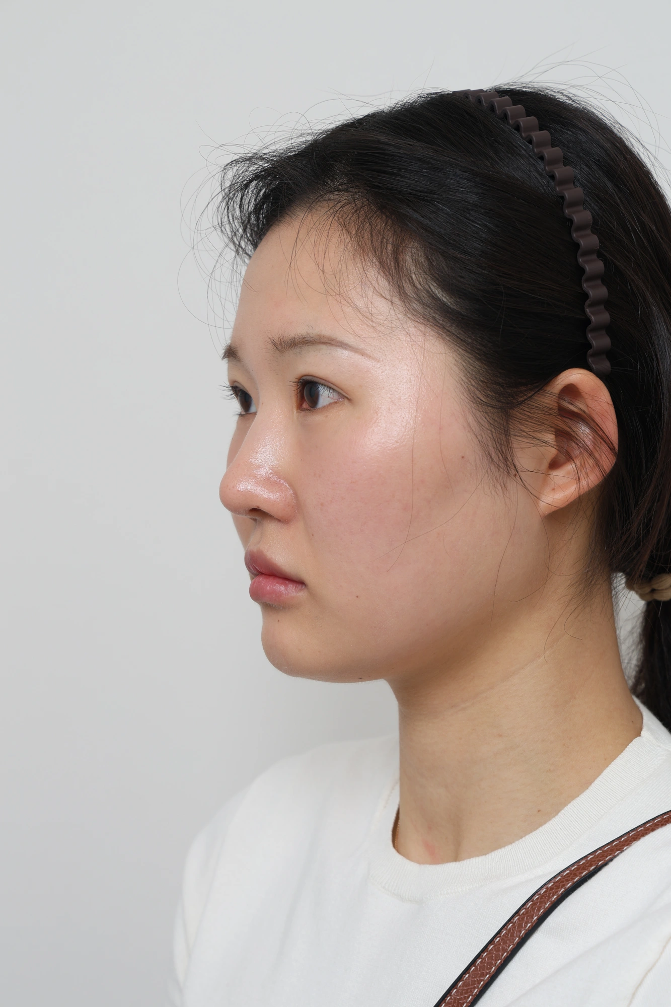 Nose and facial profile — collection 04 at Le J Plastic Surgery Clinic. Le J Clinic, Seoul, collection 04: opposite side view; source folder labelled 3 months.