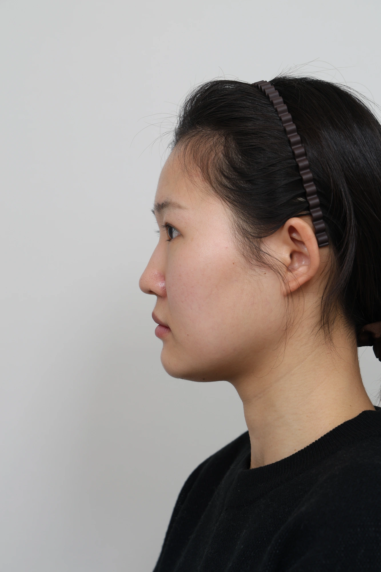 Nose and facial profile — collection 04 at Le J Plastic Surgery Clinic. Le J Clinic, Seoul, collection 04: opposite side view; initial op-folder photograph.