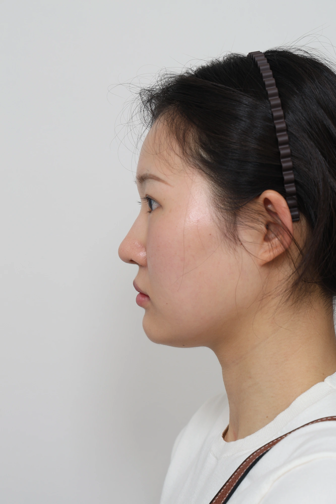 Nose and facial profile — collection 04 at Le J Plastic Surgery Clinic. Le J Clinic, Seoul, collection 04: additional side view; source folder labelled 3 months.