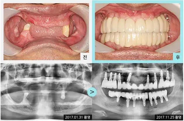 Full-mouth implant comparison 1: teeth and panoramic views at Lime Tree Dental Hospital. Lime Tree Dental Hospital — Full-mouth implant comparison 1: teeth and panoramic views. Clinical before and after views above panoramic radiographs labelled 2017-01-31 and 2017-11-25; original left-to-right sequence retained.