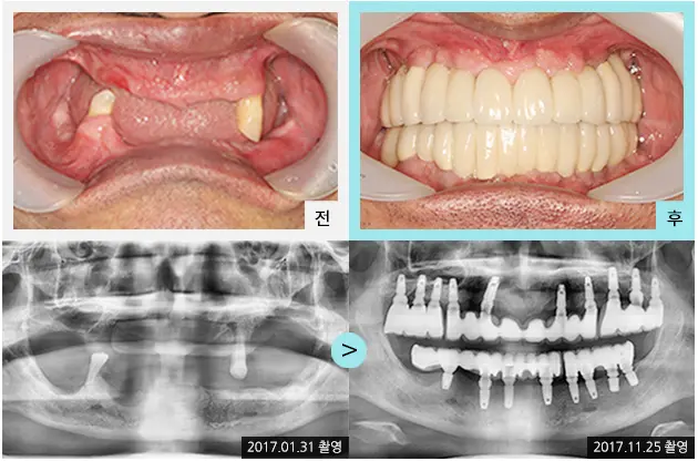 Full-mouth implant comparison 1: teeth and panoramic views at Lime Tree Dental Hospital. Lime Tree Dental Hospital — Full-mouth implant comparison 1: teeth and panoramic views. Clinical before and after views above panoramic radiographs labelled 2017-01-31 and 2017-11-25; original left-to-right sequence retained.
