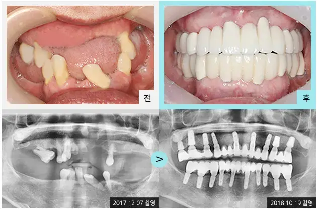 Full-mouth implant comparison 2: teeth and panoramic views at Lime Tree Dental Hospital. Lime Tree Dental Hospital — Full-mouth implant comparison 2: teeth and panoramic views. Clinical before and after views above panoramic radiographs labelled 2017-12-07 and 2018-10-19; original left-to-right sequence retained.