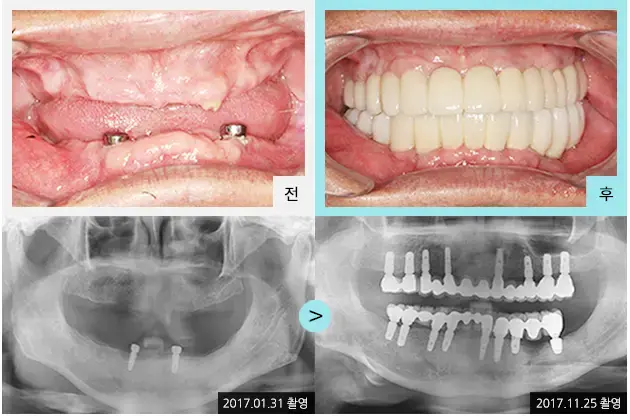 Full-mouth implant comparison 3: teeth and panoramic views at Lime Tree Dental Hospital. Lime Tree Dental Hospital — Full-mouth implant comparison 3: teeth and panoramic views. Clinical before and after views above panoramic radiographs labelled 2017-01-31 and 2017-11-25; original left-to-right sequence retained.