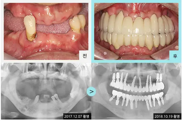 Full-mouth implant comparison 4: teeth and panoramic views at Lime Tree Dental Hospital. Lime Tree Dental Hospital — Full-mouth implant comparison 4: teeth and panoramic views. Clinical before and after views above panoramic radiographs labelled 2017-12-07 and 2018-10-19; original left-to-right sequence retained.