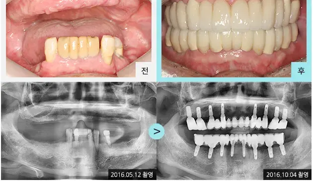 Full-mouth implant comparison 5: teeth and panoramic views at Lime Tree Dental Hospital. Lime Tree Dental Hospital — Full-mouth implant comparison 5: teeth and panoramic views. Clinical before and after views above panoramic radiographs labelled 2016-05-12 and 2016-10-04; original left-to-right sequence retained.