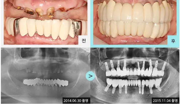 Full-mouth implant comparison 6: teeth and panoramic views at Lime Tree Dental Hospital. Lime Tree Dental Hospital — Full-mouth implant comparison 6: teeth and panoramic views. Clinical before and after views above panoramic radiographs labelled 2014-06-30 and 2015-11-04; original left-to-right sequence retained.