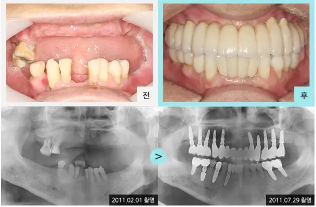 Full-mouth implant comparison 7: teeth and panoramic views at Lime Tree Dental Hospital. Lime Tree Dental Hospital — Full-mouth implant comparison 7: teeth and panoramic views. Clinical before and after views above panoramic radiographs labelled 2011-02-01 and 2011-07-29; original left-to-right sequence retained.