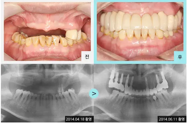 Full-mouth implant comparison 8: teeth and panoramic views at Lime Tree Dental Hospital. Lime Tree Dental Hospital — Full-mouth implant comparison 8: teeth and panoramic views. Clinical before and after views above panoramic radiographs labelled 2014-04-18 and 2014-06-11; original left-to-right sequence retained.