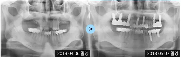 Dental implant X-rays: 2013-04-06 to 2013-05-07 at Lime Tree Dental Hospital. Lime Tree Dental Hospital — Dental implant X-rays: 2013-04-06 to 2013-05-07. Before and later panoramic radiographs, labelled 2013-04-06 and 2013-05-07. Dates refer to the X-rays, not a confirmed final-restoration follow-up.