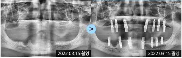 Full-mouth implants: dental views and X-rays at Lime Tree Dental Hospital. Lime Tree Dental Hospital — Full-mouth implants: dental views and X-rays. Panoramic pair; both source labels read 15 March 2022.