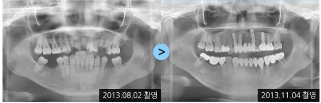 Dental implant X-rays: 2013-08-02 to 2013-11-04 at Lime Tree Dental Hospital. Lime Tree Dental Hospital — Dental implant X-rays: 2013-08-02 to 2013-11-04. Before and later panoramic radiographs, labelled 2013-08-02 and 2013-11-04. Dates refer to the X-rays, not a confirmed final-restoration follow-up.