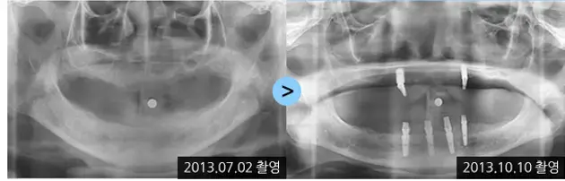 Dental implant X-rays: 2013-07-02 to 2013-10-10 at Lime Tree Dental Hospital. Lime Tree Dental Hospital — Dental implant X-rays: 2013-07-02 to 2013-10-10. Before and later panoramic radiographs, labelled 2013-07-02 and 2013-10-10. Dates refer to the X-rays, not a confirmed final-restoration follow-up.