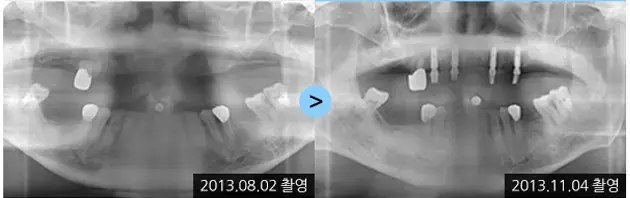 Implant X-rays with remaining lower teeth: 2013 comparison at Lime Tree Dental Hospital. Lime Tree Dental Hospital — Implant X-rays with remaining lower teeth: 2013 comparison. Before and later panoramic radiographs, labelled 2013-08-02 and 2013-11-04. Dates refer to the X-rays, not a confirmed final-restoration…
