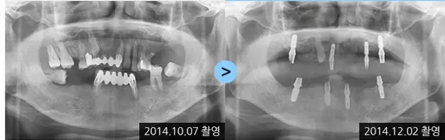 Dental implant X-rays: 2014-10-07 to 2014-12-02 at Lime Tree Dental Hospital. Lime Tree Dental Hospital — Dental implant X-rays: 2014-10-07 to 2014-12-02. Before and later panoramic radiographs, labelled 2014-10-07 and 2014-12-02. Dates refer to the X-rays, not a confirmed final-restoration follow-up.