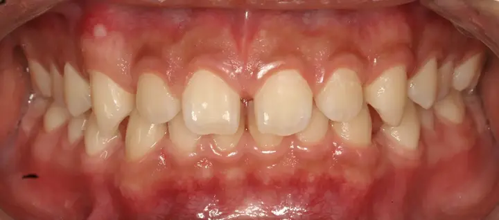 Veneers: tooth shape and front-tooth proportions at Lime Tree Dental Hospital. Lime Tree Dental Hospital — Veneers: tooth shape and front-tooth proportions. Before treatment.