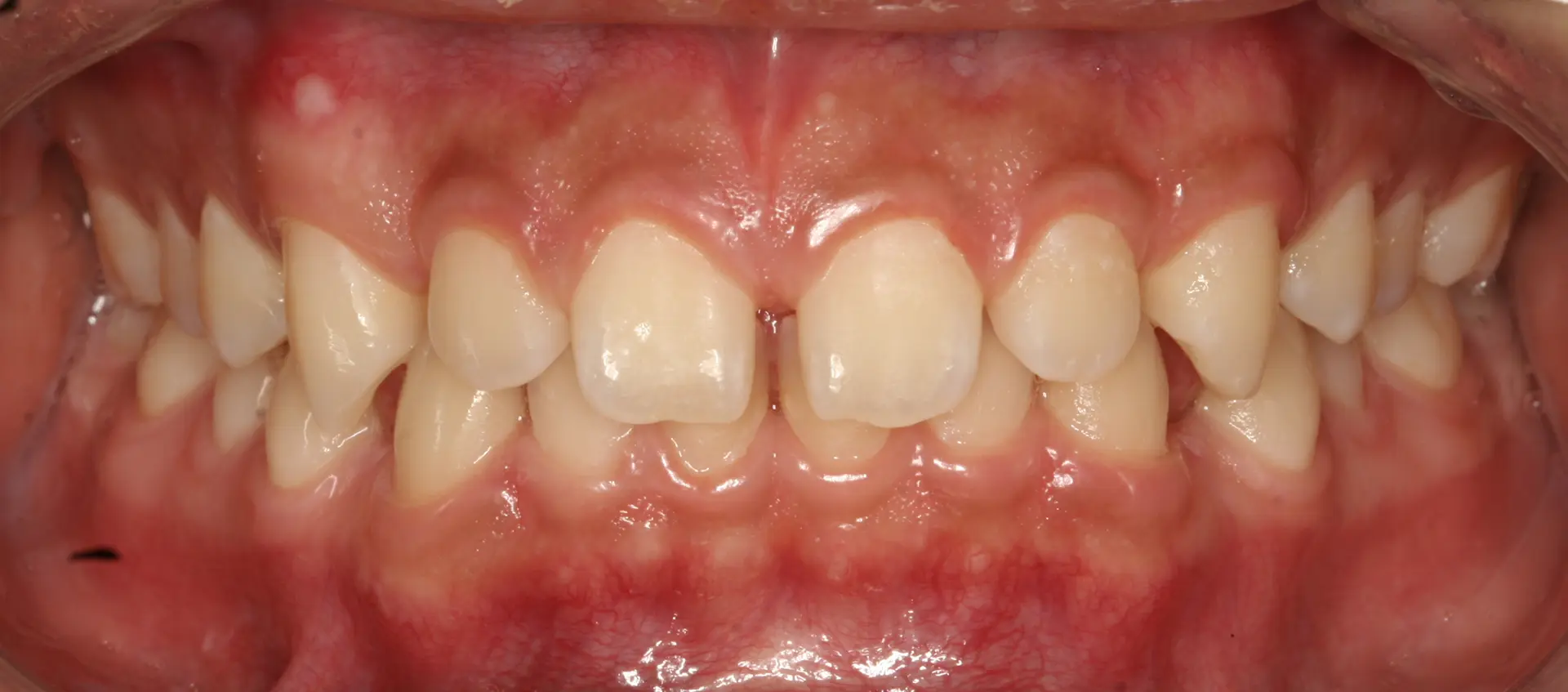 Veneers: tooth shape and front-tooth proportions at Lime Tree Dental Hospital. Lime Tree Dental Hospital — Veneers: tooth shape and front-tooth proportions. Before treatment.