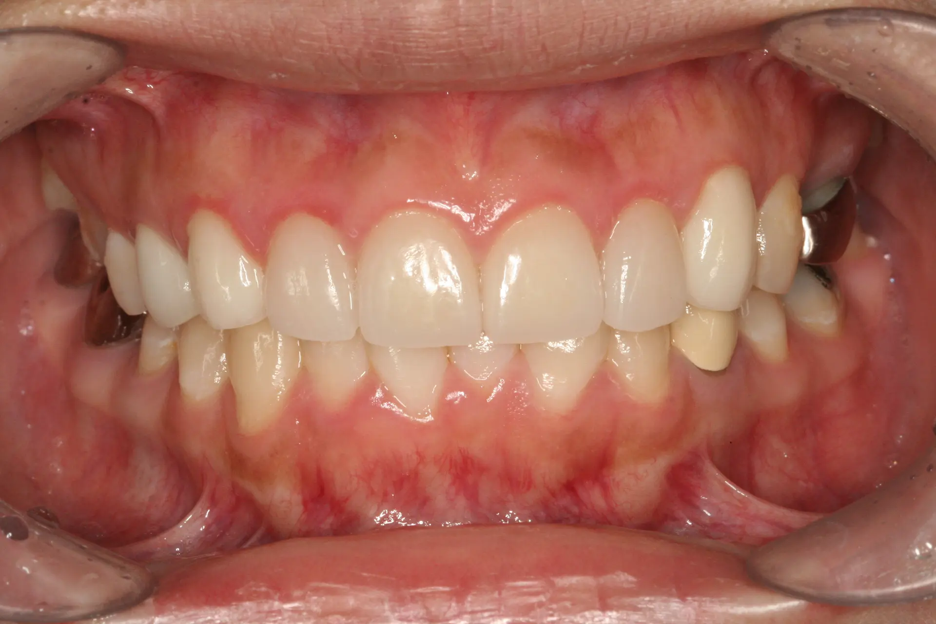 Veneers: front-tooth shape and surface detail at Lime Tree Dental Hospital. Lime Tree Dental Hospital — Veneers: front-tooth shape and surface detail. After treatment.