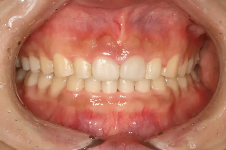 Veneers: upper front-tooth length and edge line at Lime Tree Dental Hospital. Lime Tree Dental Hospital — Veneers: upper front-tooth length and edge line. Before treatment.