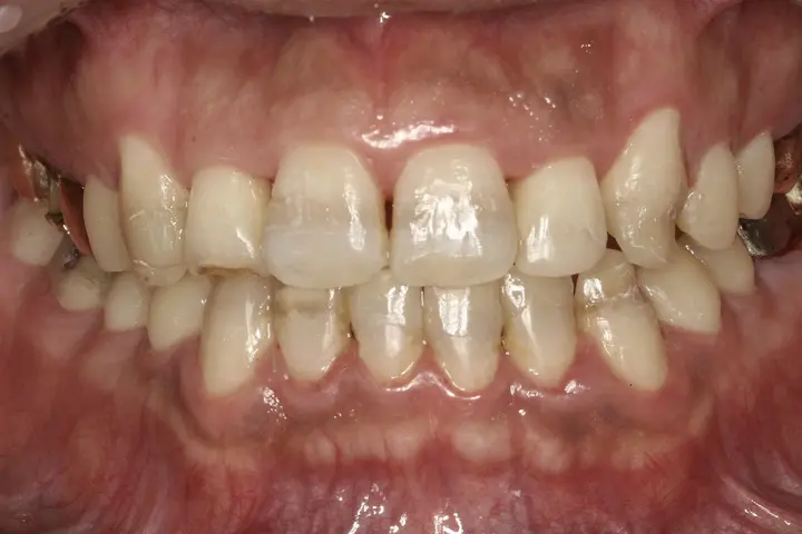 Veneers: tooth colour across the smile at Lime Tree Dental Hospital. Lime Tree Dental Hospital — Veneers: tooth colour across the smile. Before treatment.