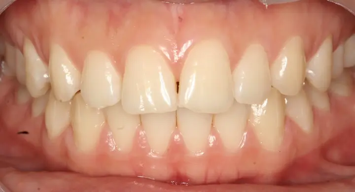 Teeth whitening: front teeth and shade variation at Lime Tree Dental Hospital. Lime Tree Dental Hospital — Teeth whitening: front teeth and shade variation. Before treatment.