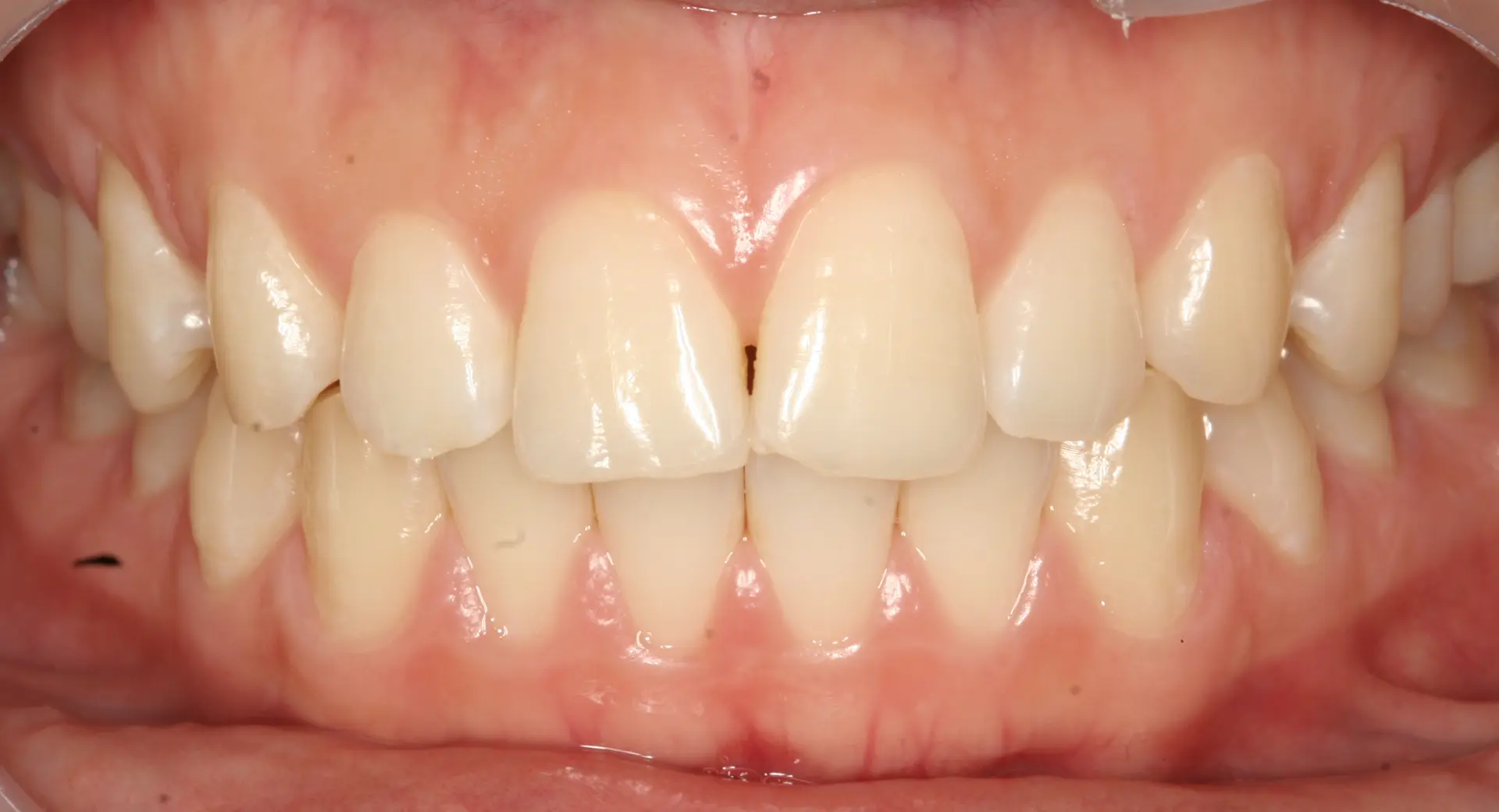 Teeth whitening: front teeth and shade variation at Lime Tree Dental Hospital. Lime Tree Dental Hospital — Teeth whitening: front teeth and shade variation. Before treatment.