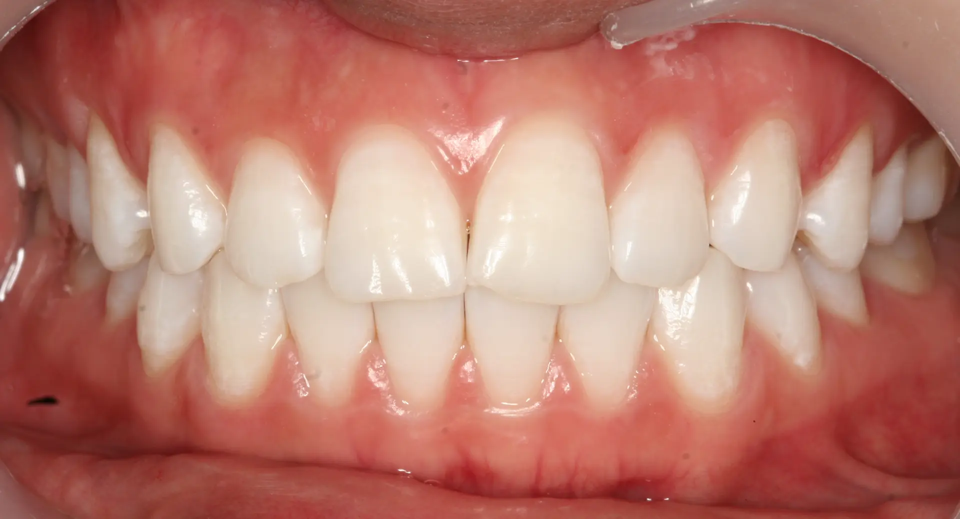 Teeth whitening: front teeth and shade variation at Lime Tree Dental Hospital. Lime Tree Dental Hospital — Teeth whitening: front teeth and shade variation. After treatment.