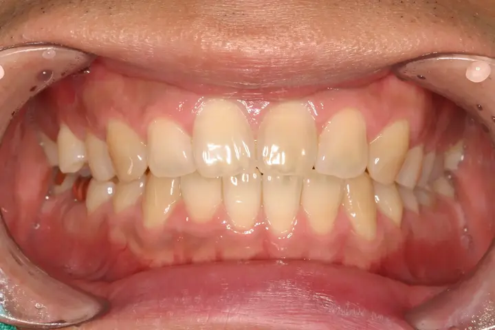 Teeth whitening: upper and lower teeth in a wider view at Lime Tree Dental Hospital. Lime Tree Dental Hospital — Teeth whitening: upper and lower teeth in a wider view. Before treatment.