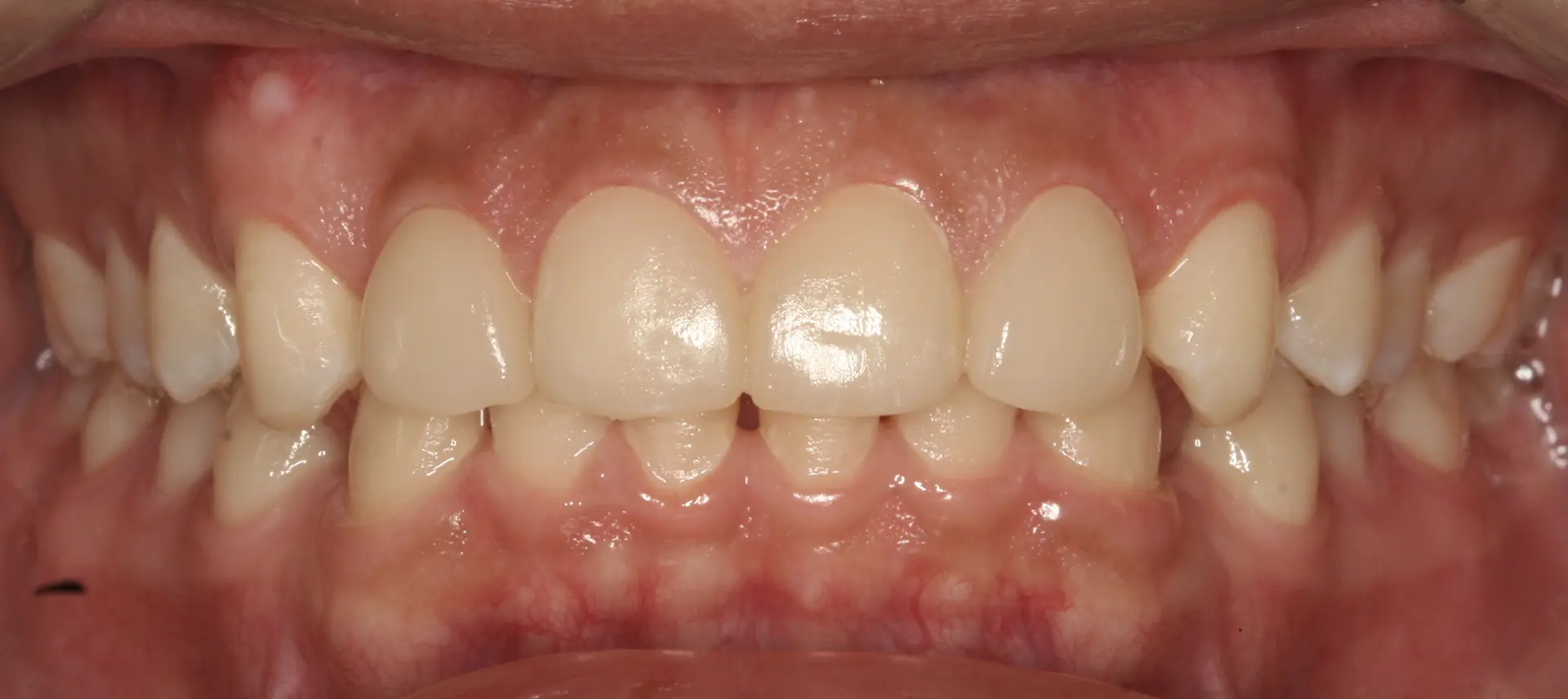 Veneers: tooth shape and front-tooth proportions at Lime Tree Dental Hospital. Lime Tree Dental Hospital — Veneers: tooth shape and front-tooth proportions. After treatment.
