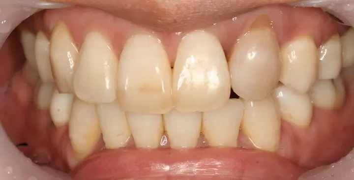 Teeth whitening: front-tooth close-up at Lime Tree Dental Hospital. Lime Tree Dental Hospital — Teeth whitening: front-tooth close-up. Before treatment.
